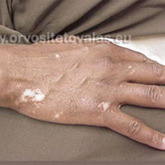 Vitiligo tetoválás