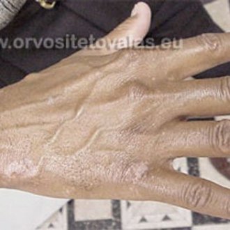 Vitiligo tetoválás
